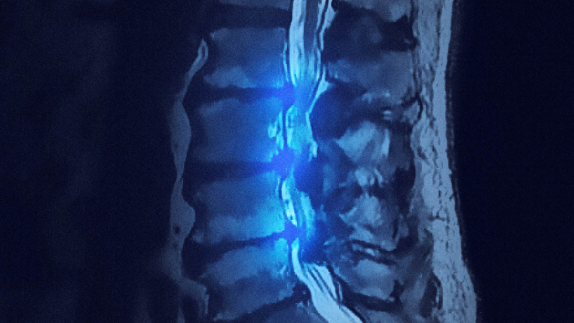 Spinal Stenosis