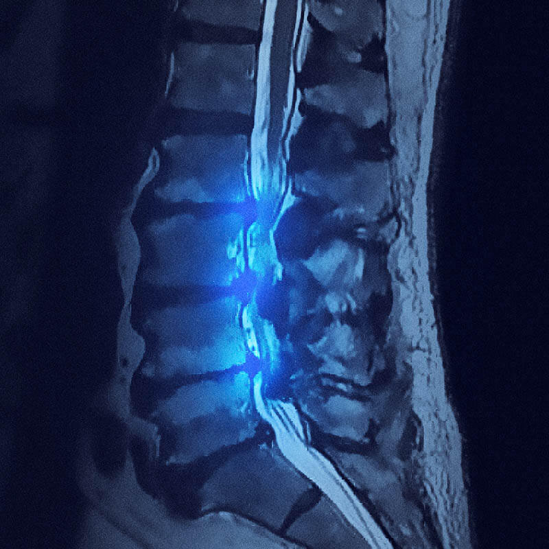 spinal stenosis