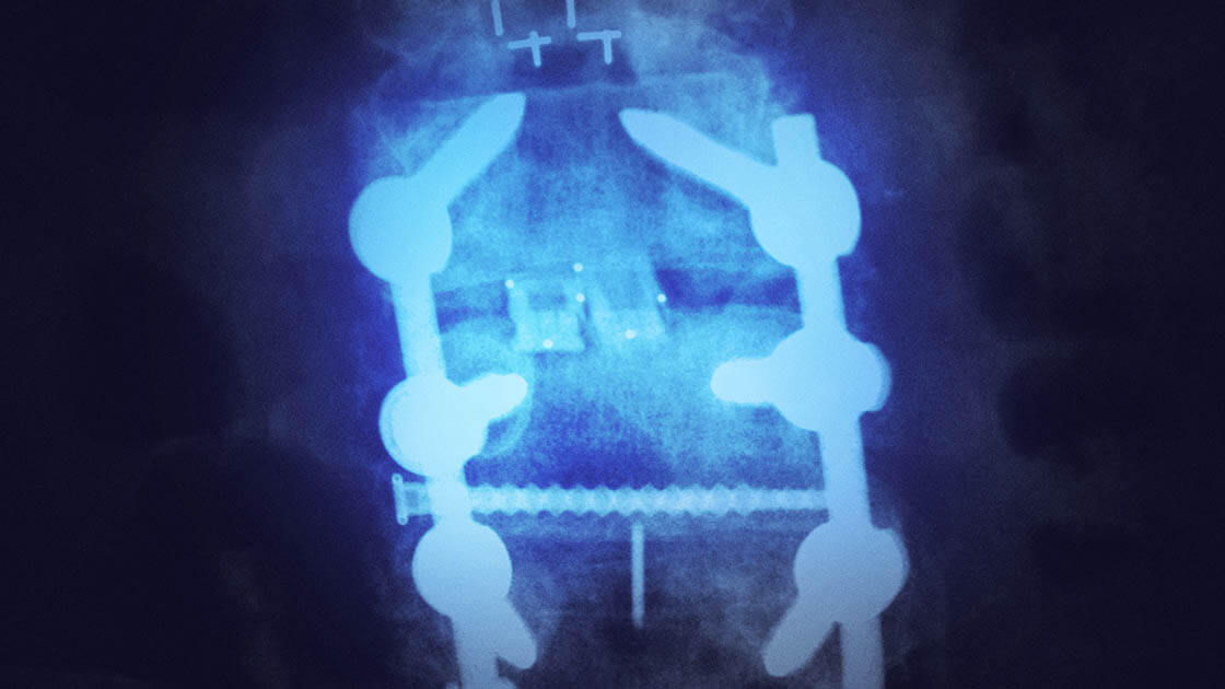 failed back surgery