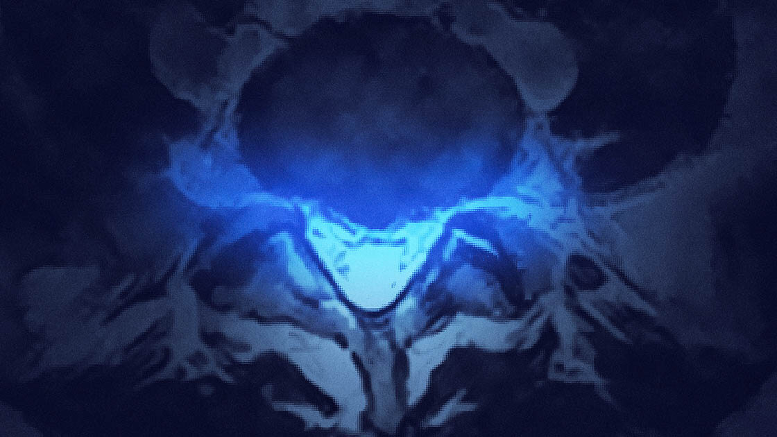 herniated disc