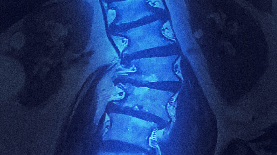 scoliosis