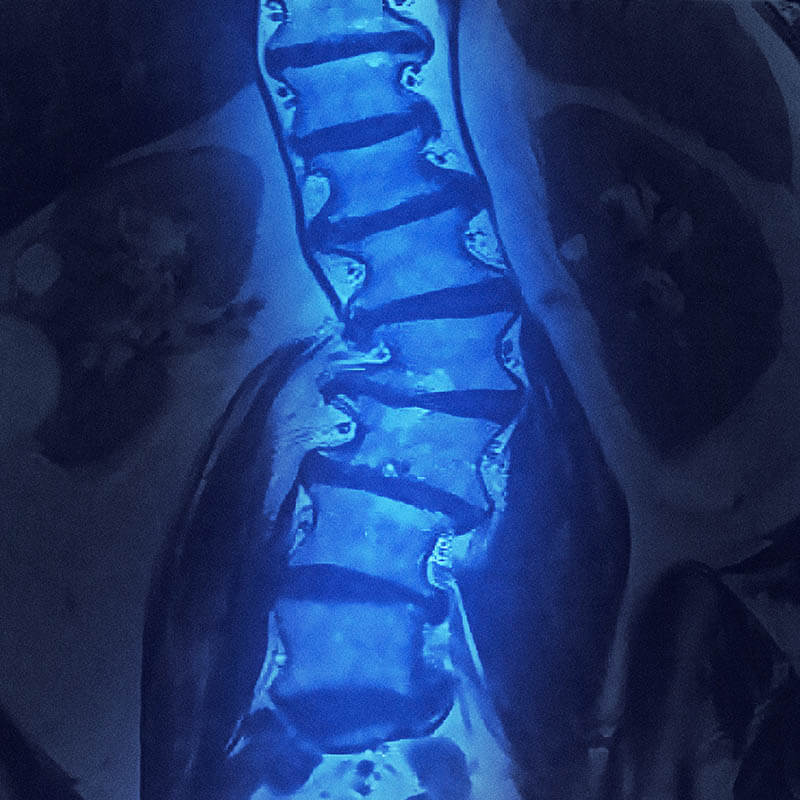 scoliosis