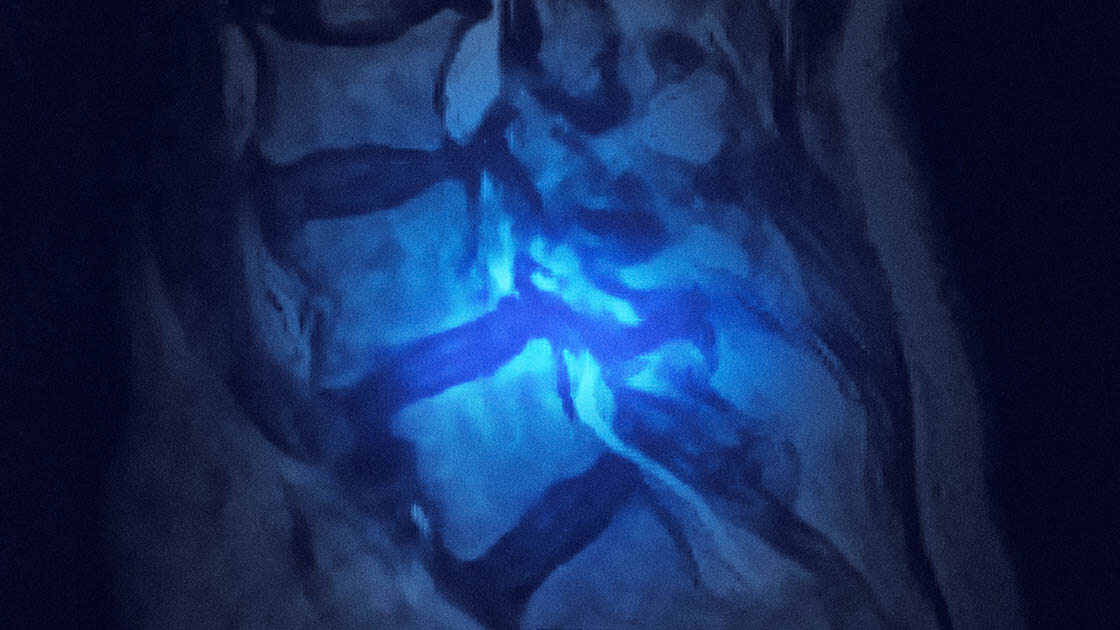 spondylolisthesis