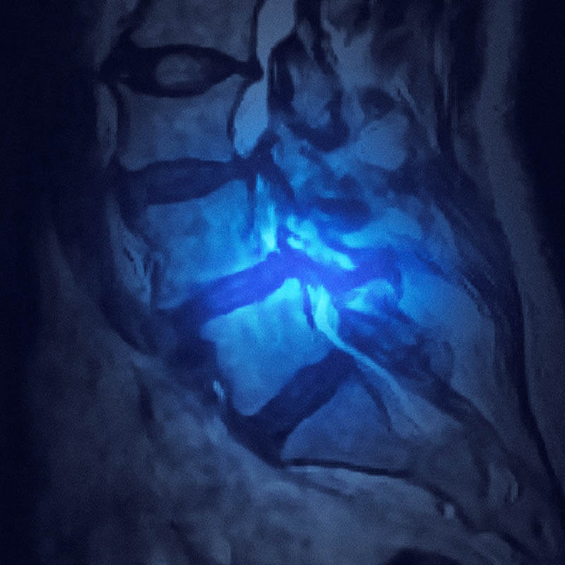 spondylolisthesis